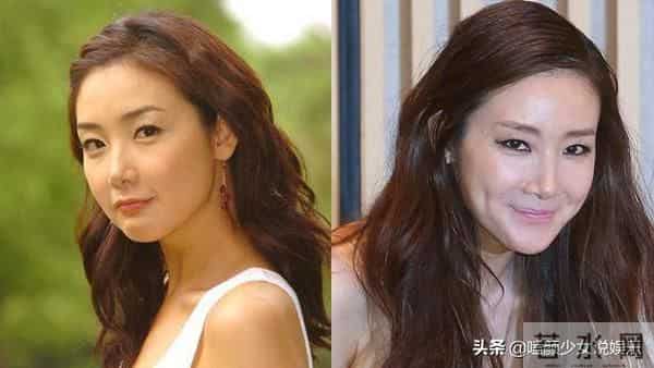 张瑞希整容失败