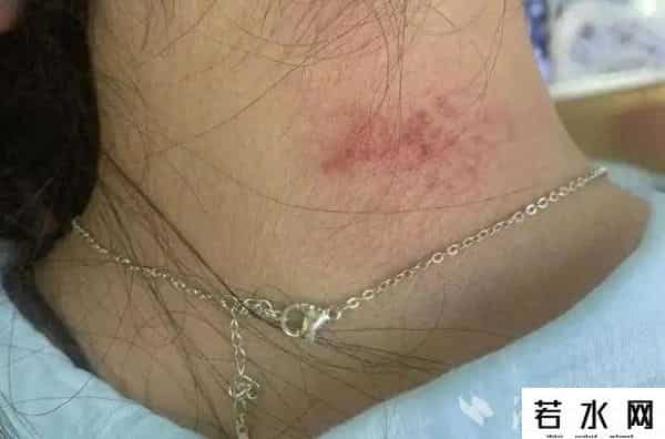 美丽说测试,“美丽首饰”高毒性重金属超标1179倍？有人已中招！医生紧急提醒