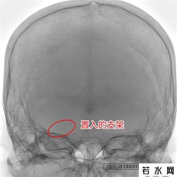 张晓枫,2个月内脑梗两次 脑血管里“穿针引线”妙手“疏堵”