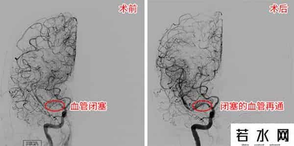 张晓枫,2个月内脑梗两次 脑血管里“穿针引线”妙手“疏堵”