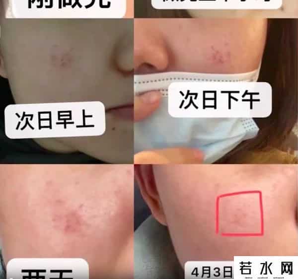 网友曝在赫莲娜做护理致脸部烧伤