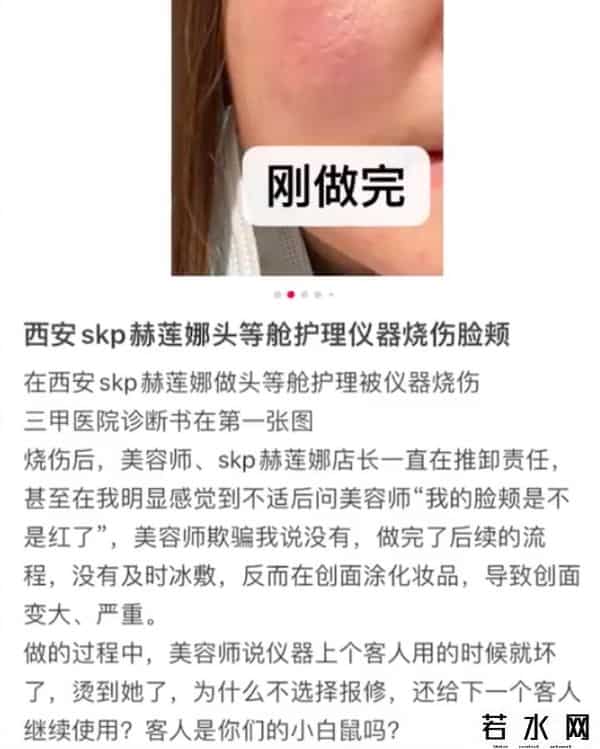 网友曝在赫莲娜做护理致脸部烧伤