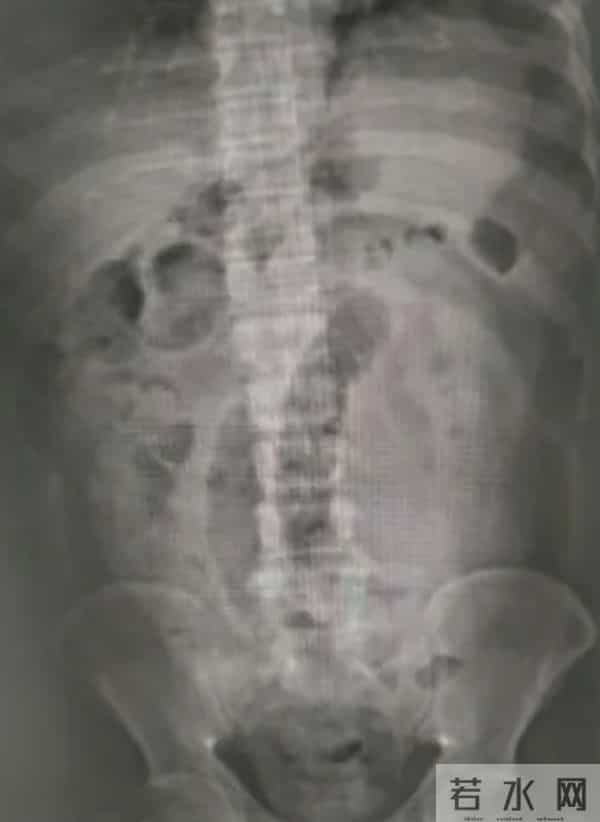 男子连吃3根生香蕉致肠梗阻