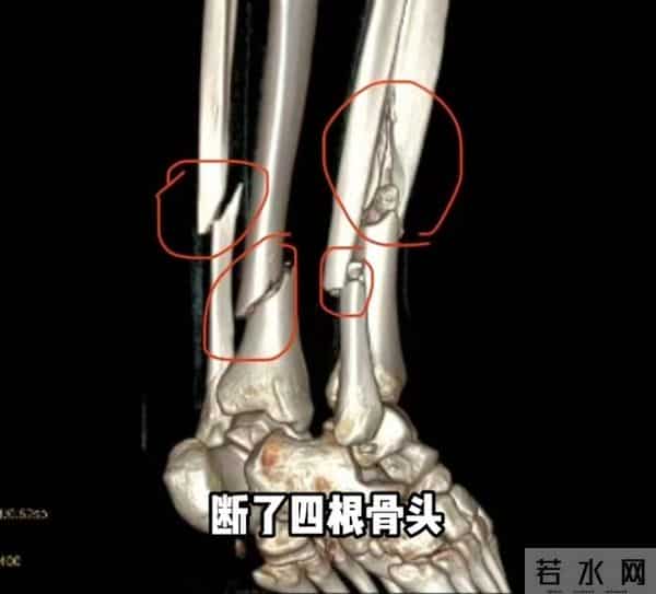 网红跳水粉碎性骨折