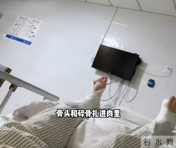 网红跳水粉碎性骨折
