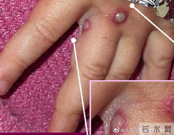 英国猴痘病例翻倍增长