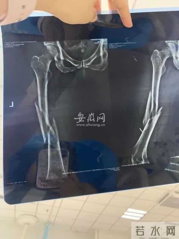 女子瑜伽课压断大腿