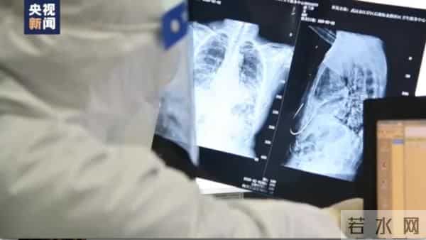 中国阳后出现肺炎人群约为8%