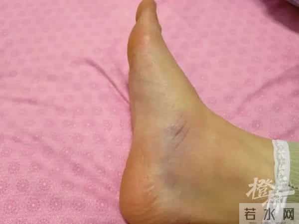 刘畊宏女孩黄体破裂
