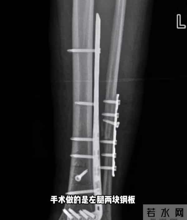 网红跳水粉碎性骨折