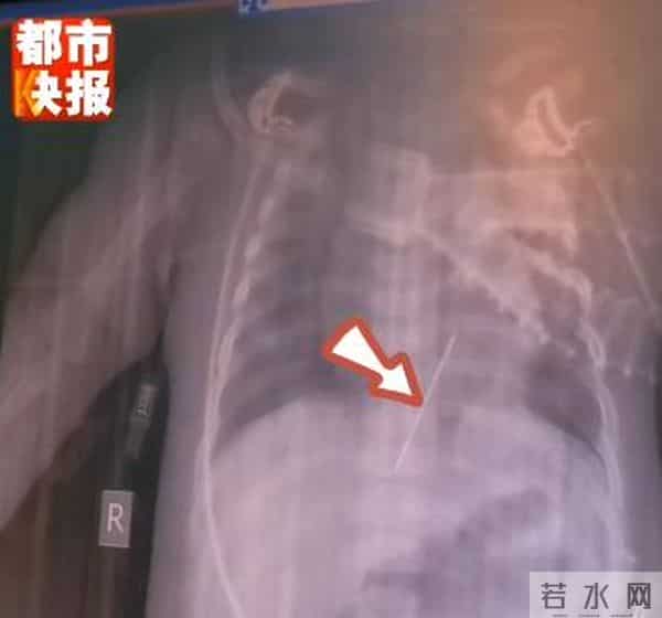 女婴心脏扎进一根4厘米绣花针