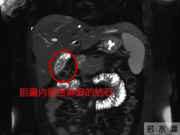 女子体内取出几百颗结石