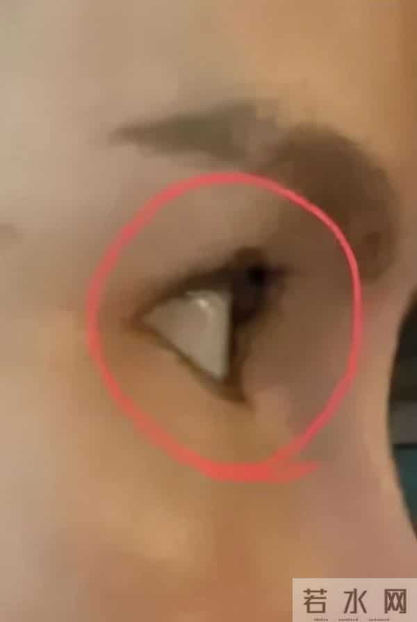 吴凡整容,20岁女孩贷款整形后鼻子歪了,医院医生:“你自己试试用手掰回来”