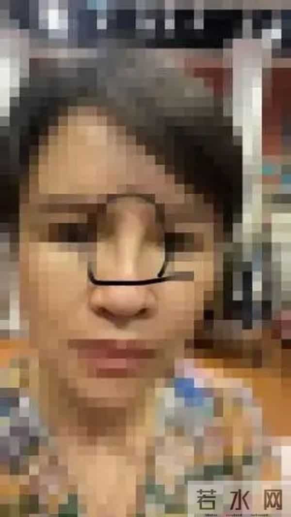吴凡整容,20岁女孩贷款整形后鼻子歪了,医院医生:“你自己试试用手掰回来”