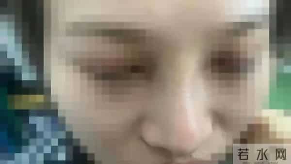 吴凡整容,20岁女孩贷款整形后鼻子歪了,医院医生:“你自己试试用手掰回来”